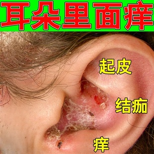 耳朵真菌感染外耳道皮屑干燥起皮流脓结痂霉菌性耳道炎专用