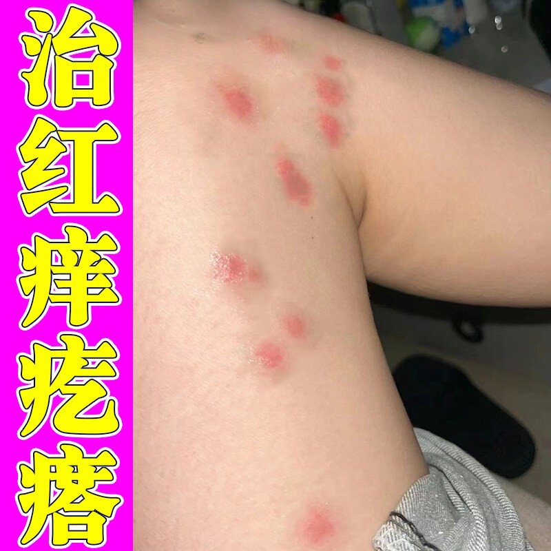 治皮肤痒的身上起红疙瘩腿上手臂出红点痒喷剂