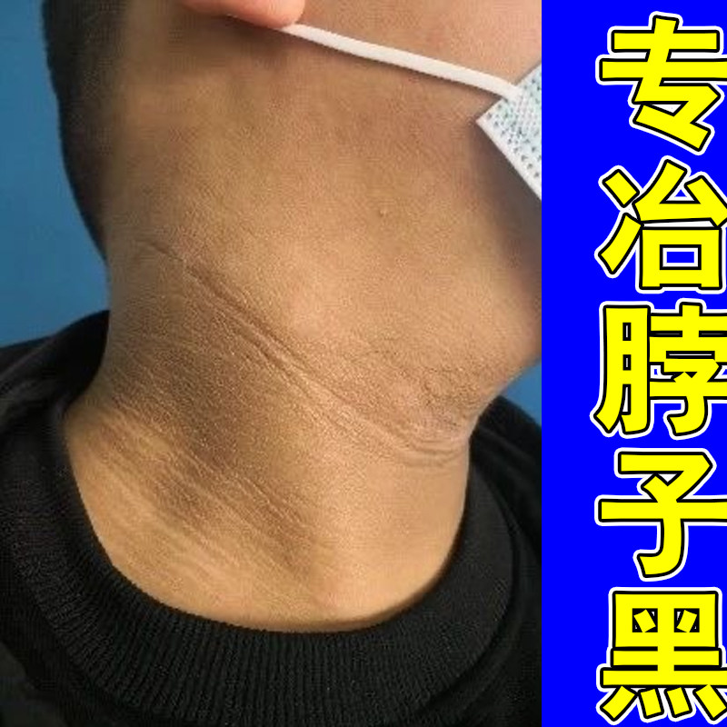 脖子黑外用药脖子黑色素沉淀身上黑印沉淀脖颈黑膏