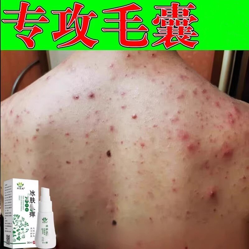 后背毛囊除马拉色菌前胸后背长痘痘痒脖子胳膊长疙瘩专用喷剂