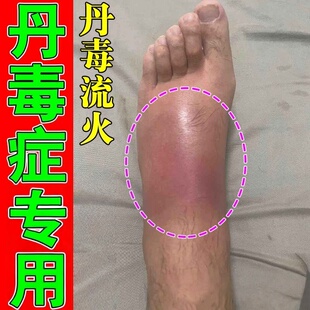治丹毒的腿脚肿胀湿热畏寒引起皮肤红肿疼痛灼热流火修复乳膏