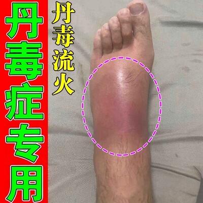 治丹毒的腿脚肿胀湿热畏寒引起皮肤红肿疼痛灼热流火修复乳膏