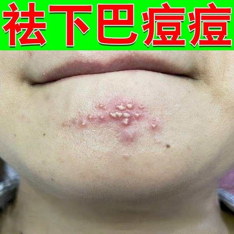 嘴边嘴角嘴巴周围下巴反复长疙瘩熬夜上火脸上淋巴腮边疙瘩