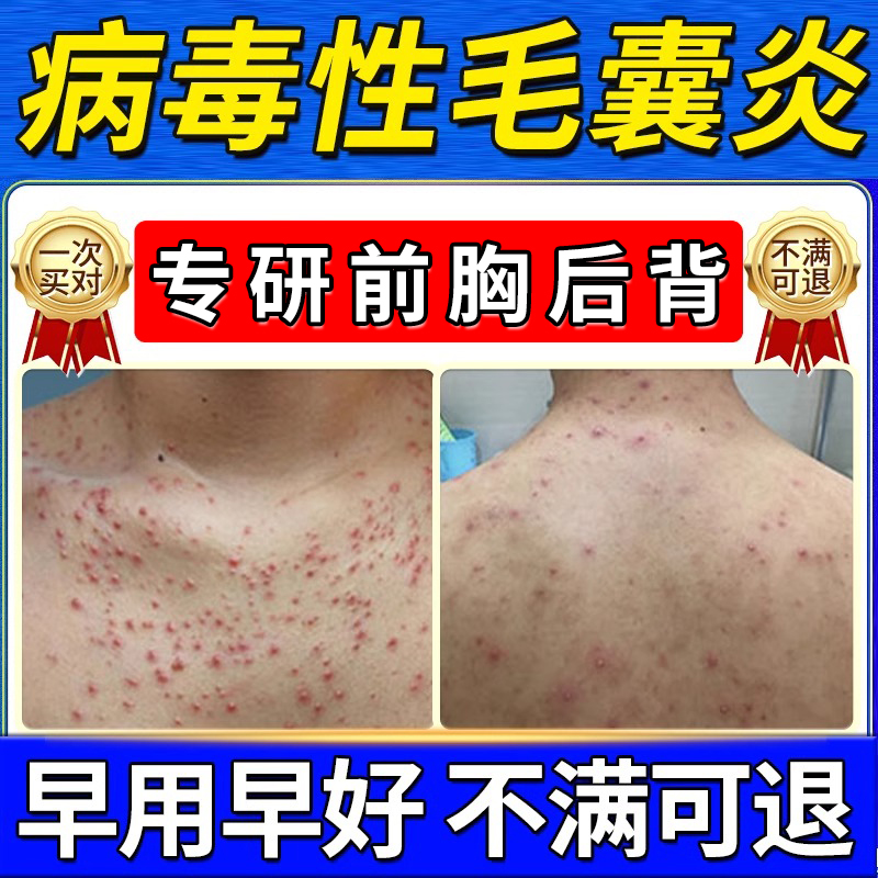 【成分温和】病毒性毛囊炎喷剂