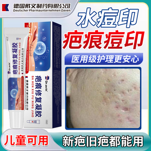 水痘疤痕修水痘坑痘印复凹洞可搭配生长因子祛陷疤膏儿童孩成人YK