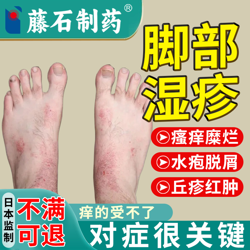 脚部湿疹止痒专用使用30天不满退
