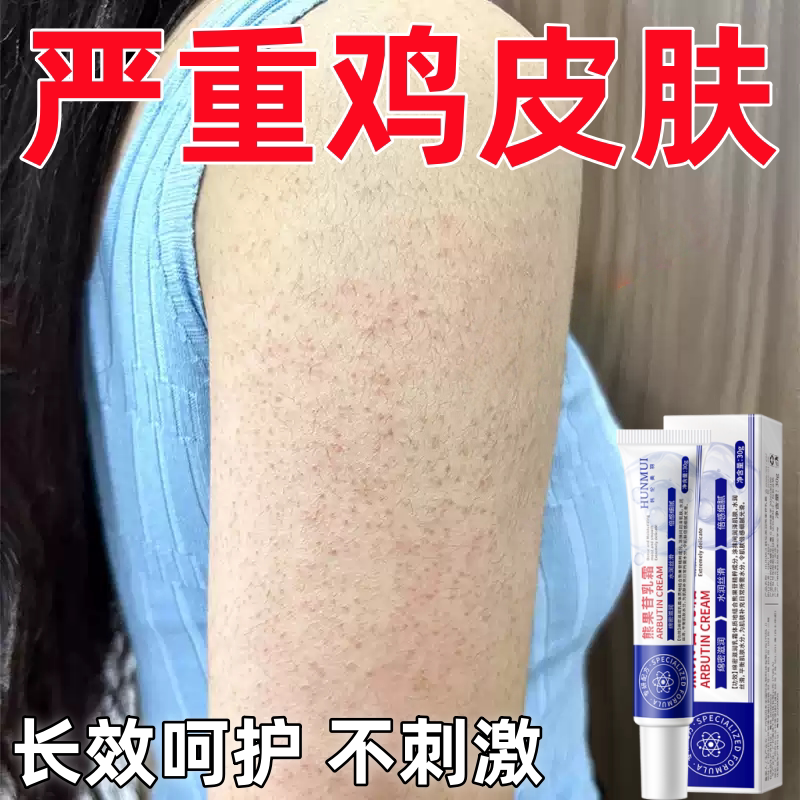 胳膊鸡皮肤疙瘩毛囊毛周角化去除症手臂脸上腿部药胳膊红点黑点膏