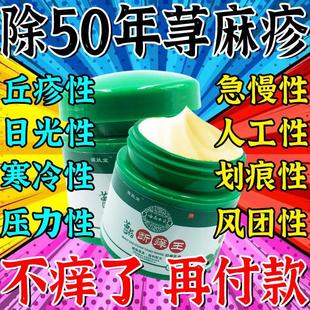 极速急慢性荨麻疹膏风疹块划痕性荨麻疹皮肤瘙R痒水肿红斑荨麻疹