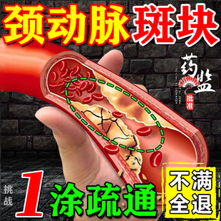 颈动脉斑块消除软化疏通血管堵塞狭窄药脑供血不足头晕头昏贴膏药