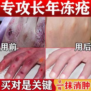 冻疮膏止痒冻伤膏正品 防裂护手霜手足耳朵脸部消肿脚后跟干裂滋润