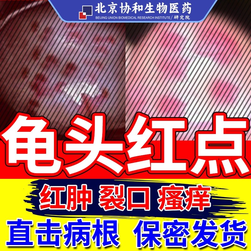 龟头上有小红点红肿裂口白垢生殖器真菌感染珍珠丘疹去除cy