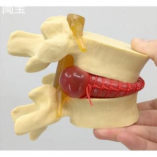 脊椎骨病理演示 人体脊柱 腰椎间盘演示突出 模型腰椎放大