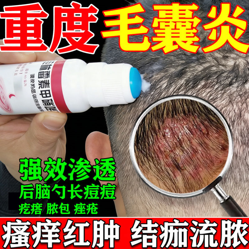 [天龙]克林霉素甲硝唑搽剂0.8%1%*40ml*1瓶/盒