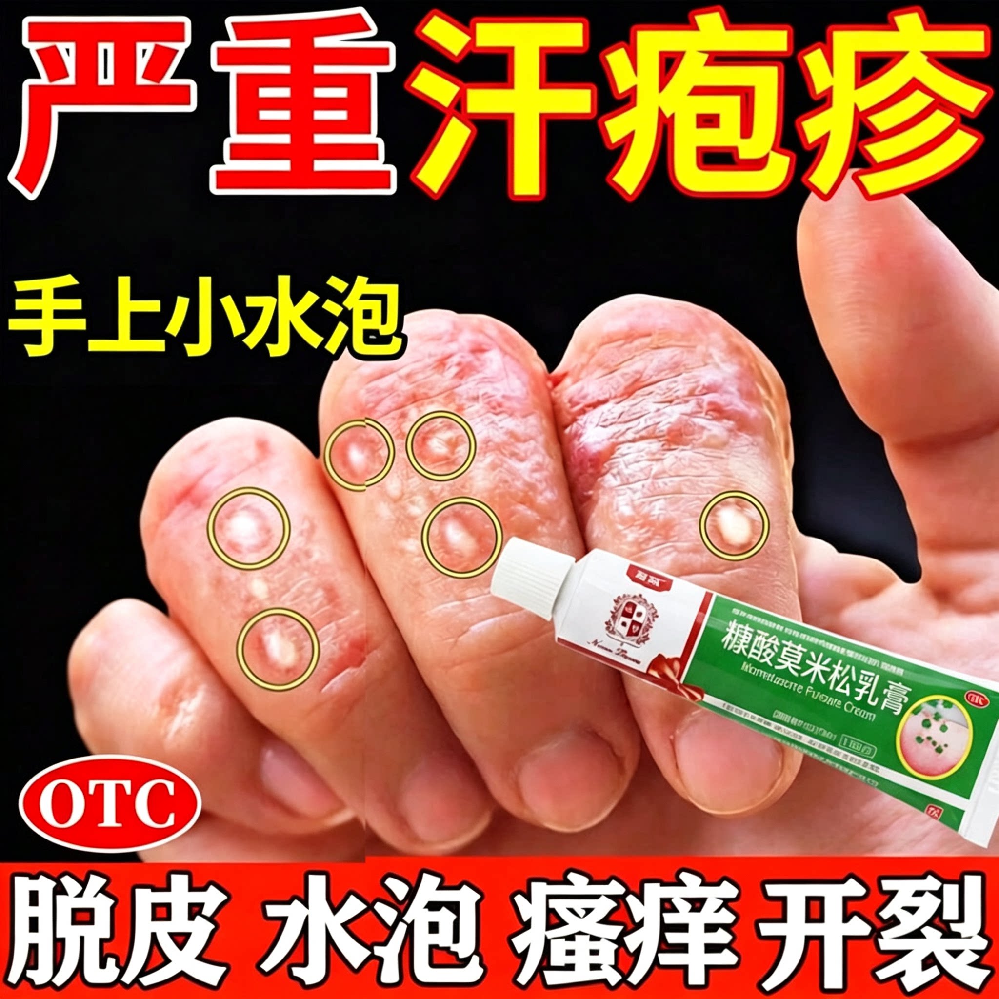 汗疱疹特药效专用止痒去手上痒起小水泡汗状疱疹真菌感染药膏医用