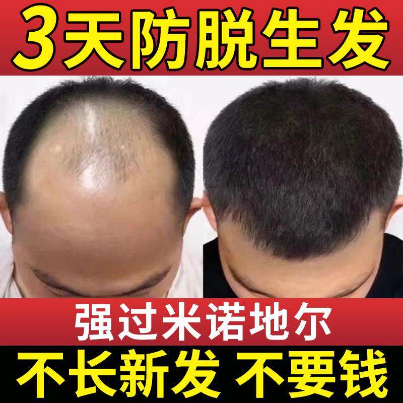 防脱育发液增发密发生发剂激活毛囊快速生长头发增长营养精华女生