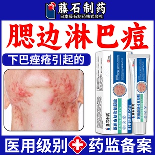 腮边痤疮下巴反复长淋巴痘腮边痘痤膏专外用药监备案结节硬块痘VP