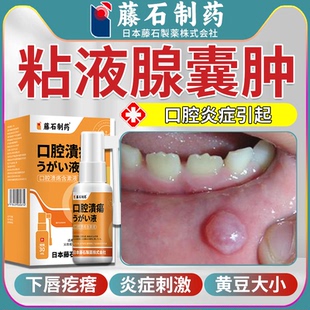 口腔炎症粘液腺囊肿黏唾液囊肿下唇长疙瘩水泡导管堵塞肉疙瘩VP