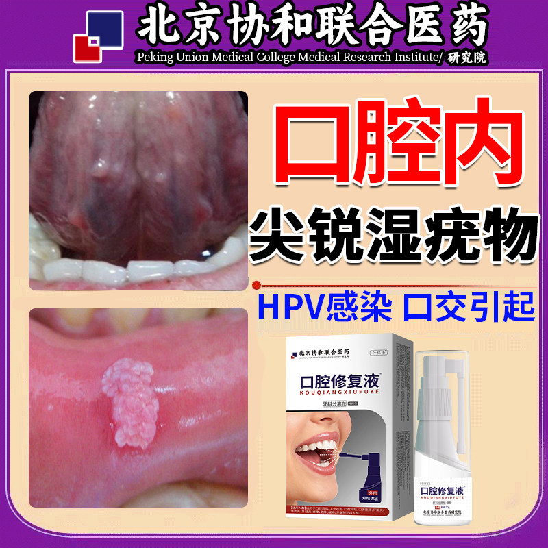 口腔内上粉红丘疹菜花状赘生物尖锐湿疣专hpv病毒感染用喷雾剂qi