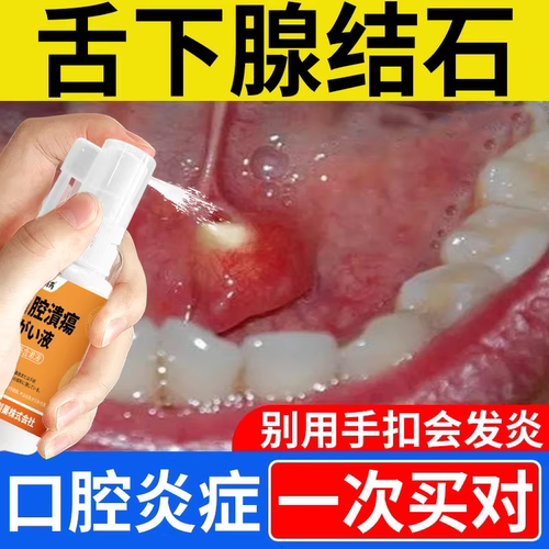 舌下腺结石黏液腺囊肿堵塞