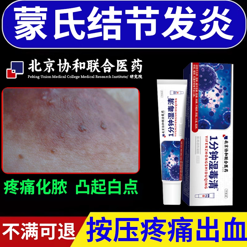 乳房蒙氏结节发炎黄点乳房小疙瘩乳腺结节专通用红褐色丘疹凸起vp