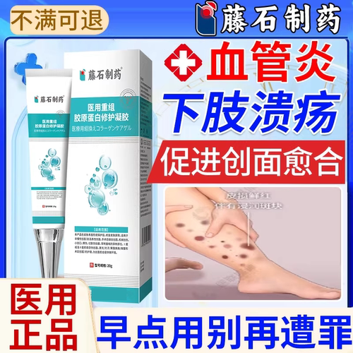 结节性血管炎红斑下肢脚踝溃疡