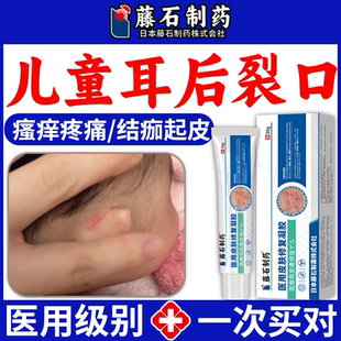 耳朵湿疹膏耳后湿疹膏耳根耳垂开裂口破溃结痂外耳道湿疹干燥VP