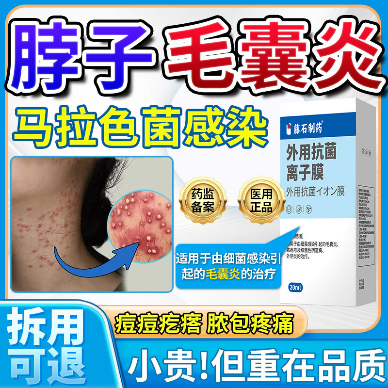 脖子上长痘痘疙瘩毛囊炎真菌感染马拉色菌痤疮腮边膏药监备案OM