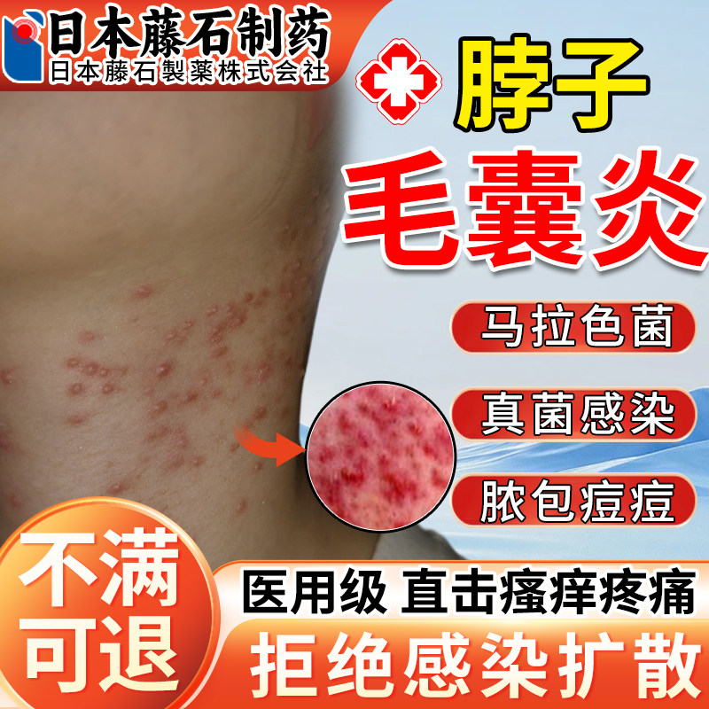 脖子上长痘痘后面疙瘩毛囊炎马拉色菌真菌感染喷雾剂药监备案HB