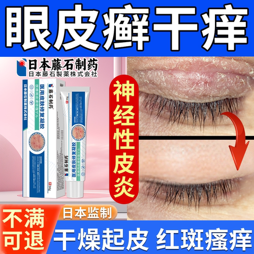 【神经性皮炎】】眼皮癣起皮瘙痒