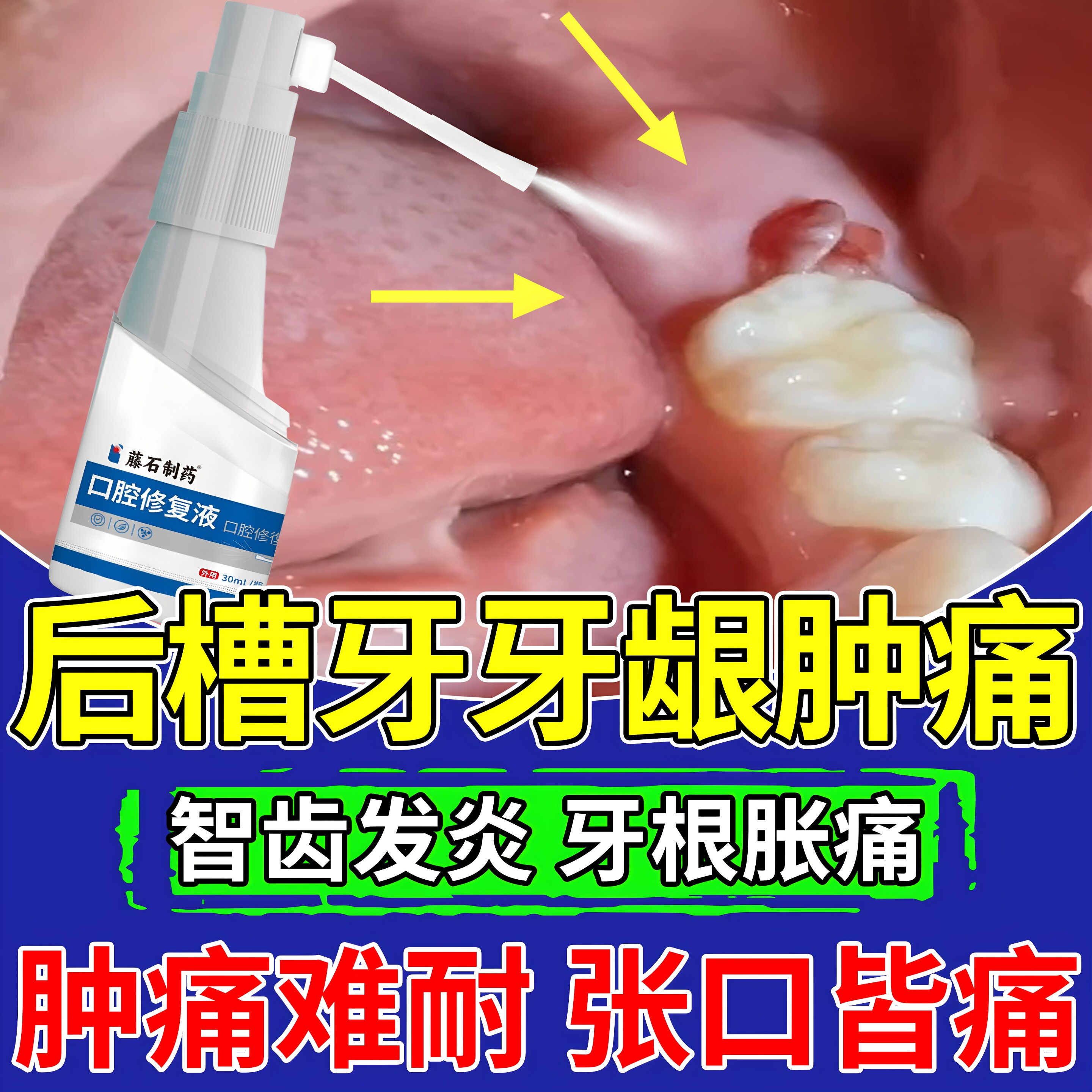 后槽牙牙龈肿痛脓包智齿牙疼冠周上火炎牙肉肿痛消可搭牙膏喷剂ZR