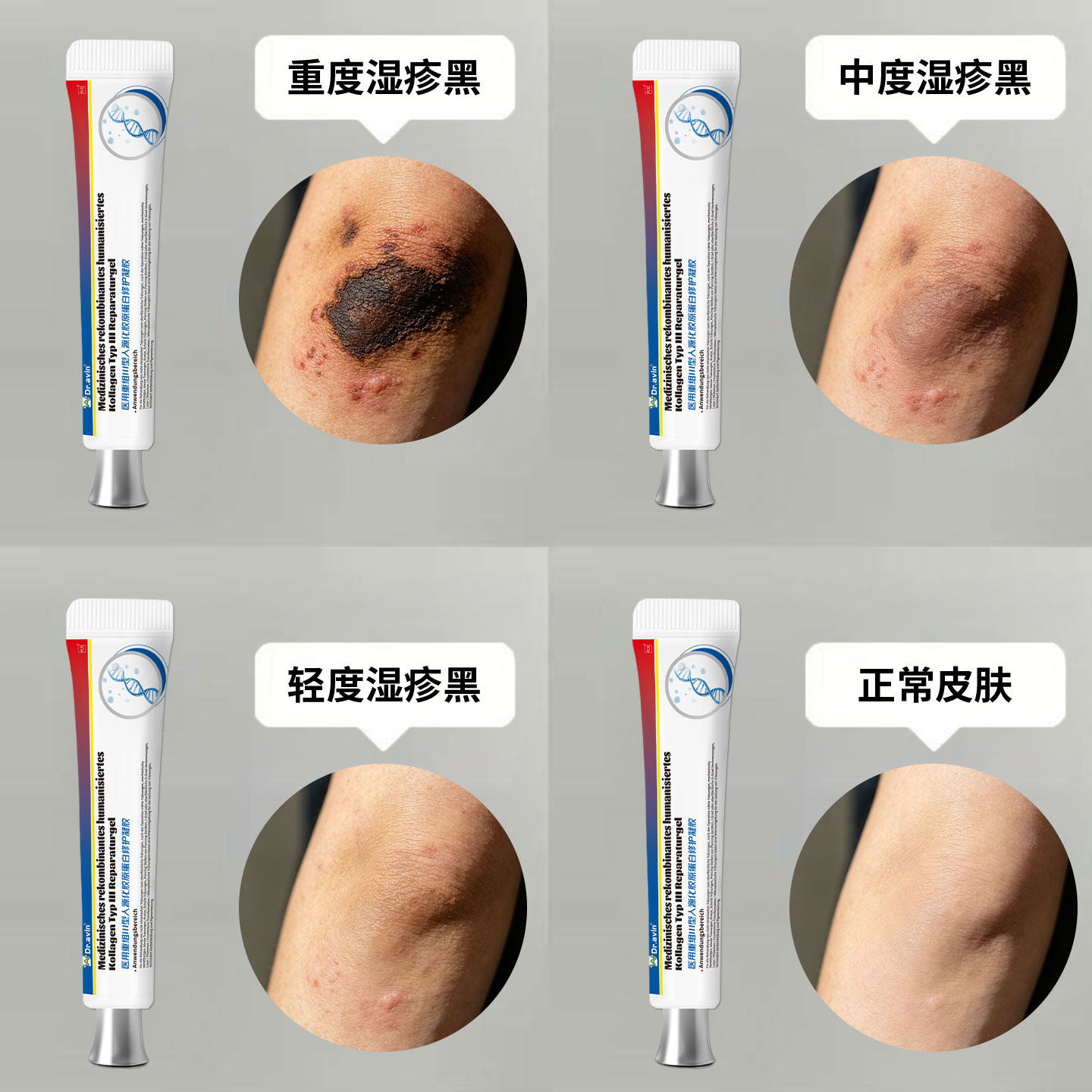 湿疹疤痕去黑色素沉淀祛疤膏淡化后背痘印手臂去除黑疤印修复膏OM