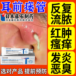 耳瘘耳前瘘管发炎搭配膏药贴清理防水流脓耳仓肿朵消滴耳液儿童OM