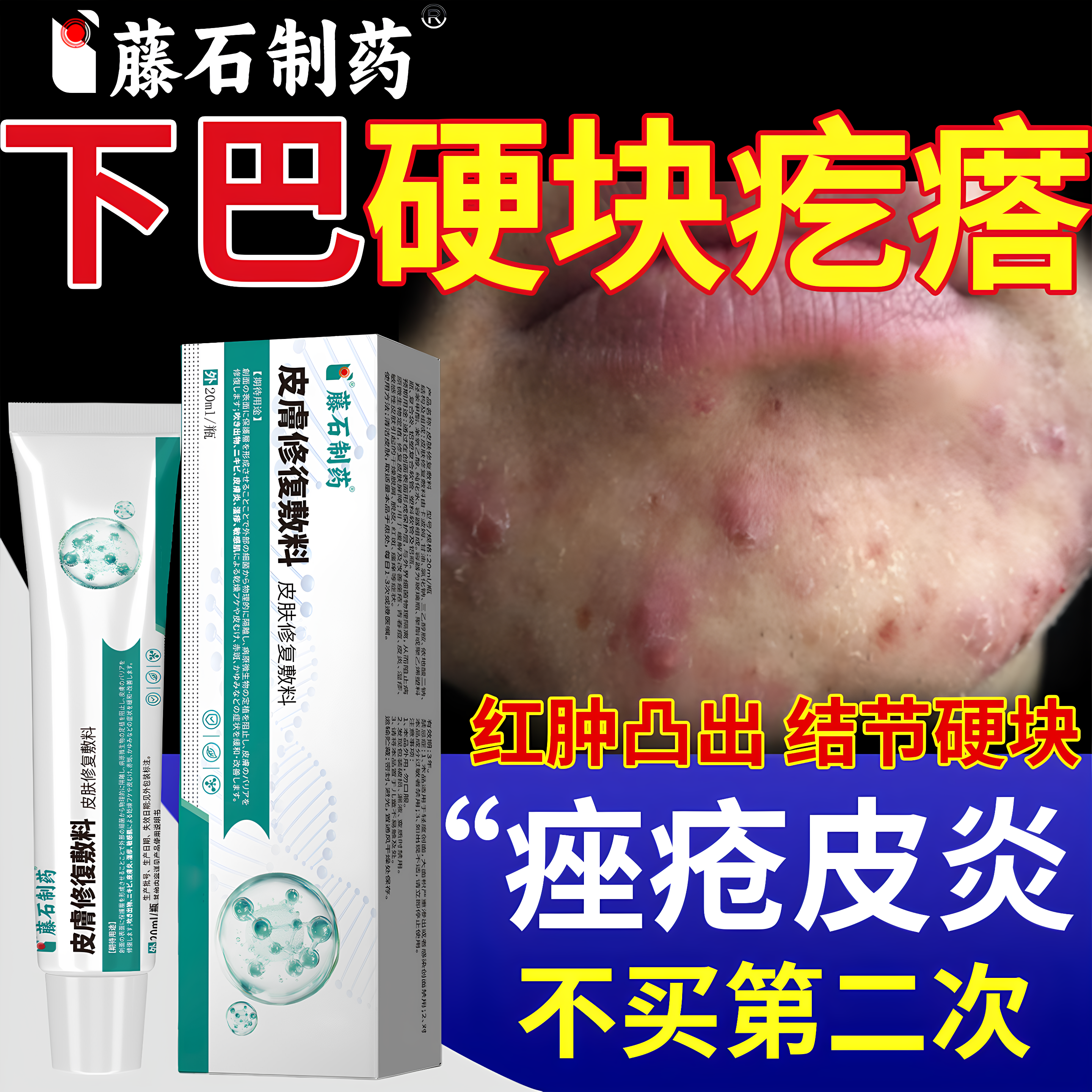 下巴反复长硬块痘痘疙瘩毛囊炎痤疮腮边淋巴痘闭口粉刺可搭药膏ZR