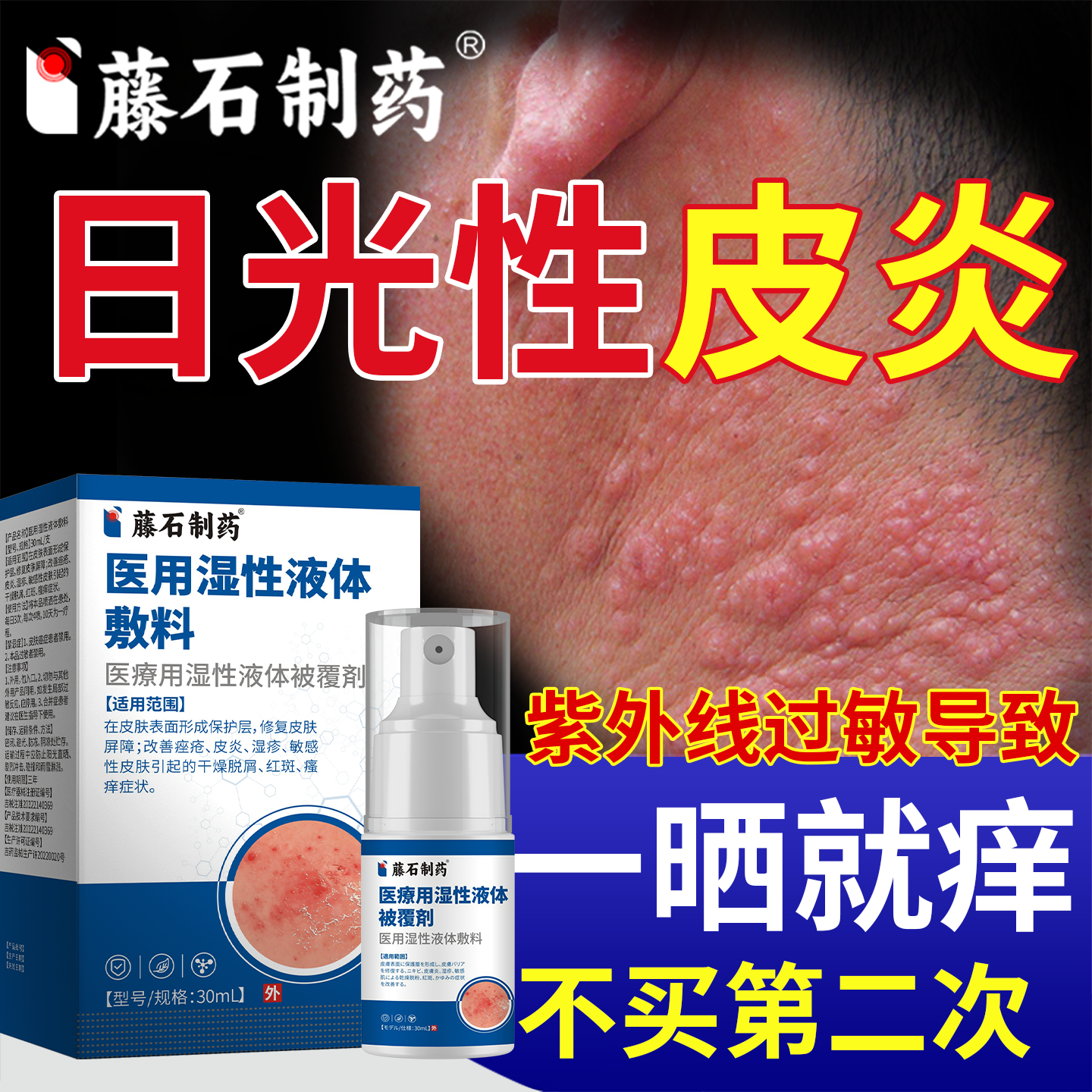 日光性皮炎紫外性过敏修复太阳晒伤皮肤瘙痒止痒专用特喷剂效ZR