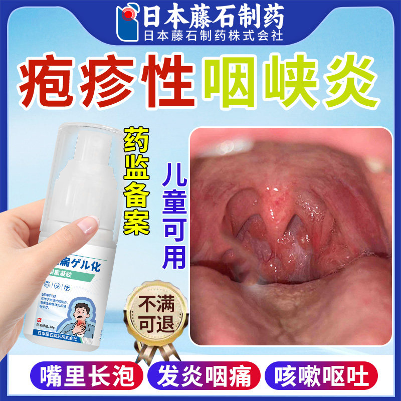 疱疹性咽峡炎儿童喷雾剂咽喉炎慢性咽炎除根口腔疱疹咳嗽异物感OM