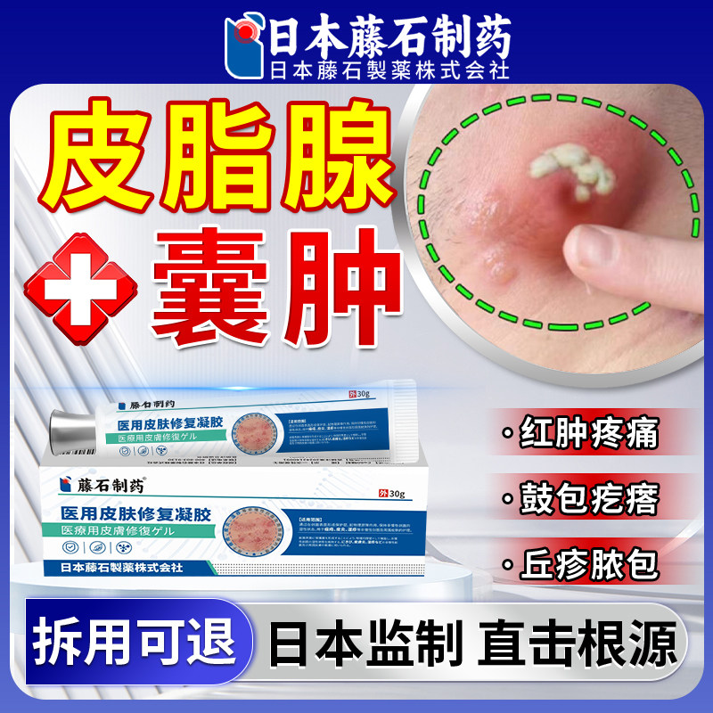 皮脂腺囊肿拔毒专用膏粉瘤粉刺针硬块结节鼓包脓包疖肿药房同售JV