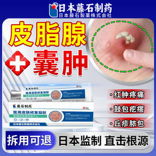 皮脂腺囊肿拔毒专用膏粉瘤粉刺针硬块结节鼓包脓包疖肿药房同售JV