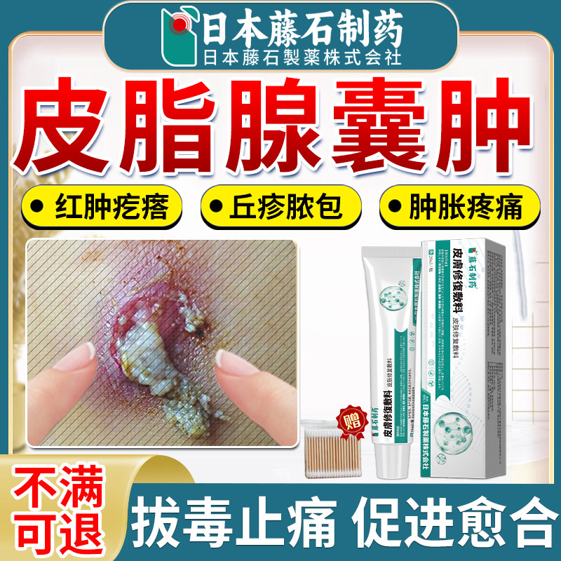 皮脂腺囊肿专用疖肿拔毒膏粉瘤粉刺板疮鼓脓包疖肿块拔毒火疖子ZR