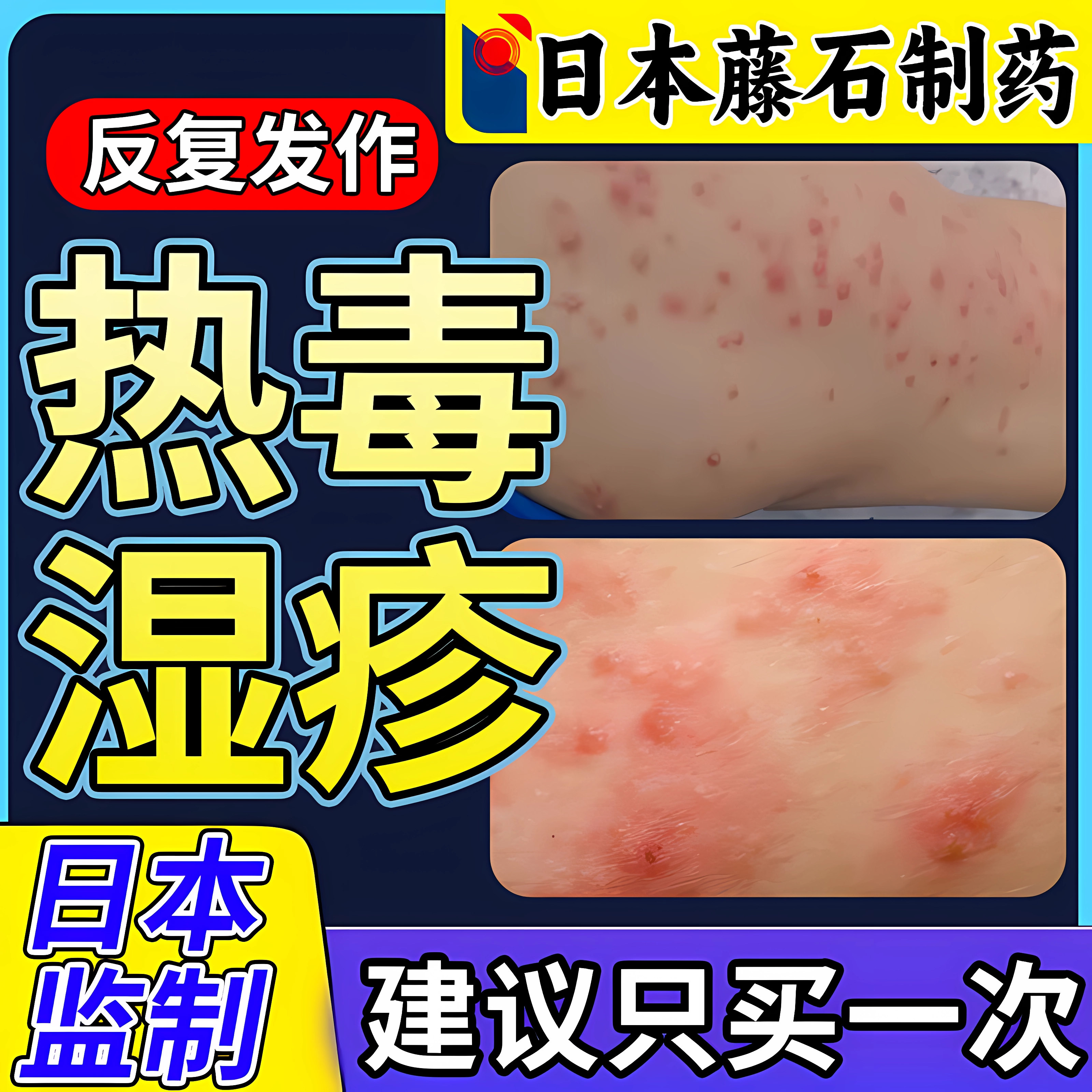 热毒湿疹专用除湿止痒膏去水泡根血热皮肤一热就痒喷雾药房同售ZR
