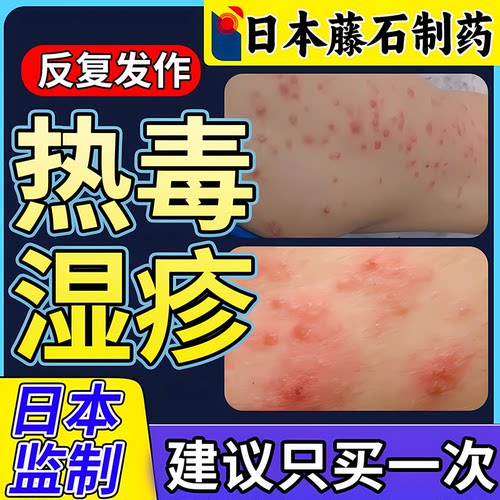 【拆用可退】热毒湿疹止痒喷雾