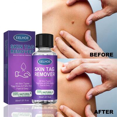 新品Eelbhoe skin wart removing liquid Remover Skin Tag Solut