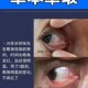 极速去除眼睛胬肉l肉疙瘩异物感眼睛干痒看不清肿胀痛专用护眼贴