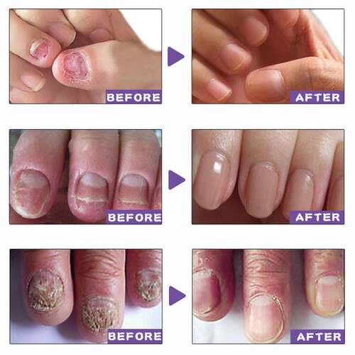 新品30ml Fungal Nailp Repair Essence Feet CareTreatment Foot