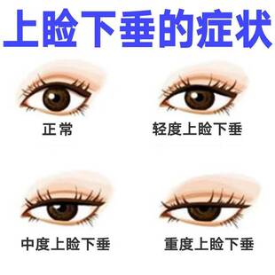 极速上眼皮下垂神器针对眼睑无力脂E肪松弛提拉紧致精致开眼角专