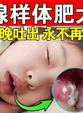 极速腺体样肥大面容矫p正器儿童宝宝睡觉张嘴呼吸不通气鼻塞嘴突