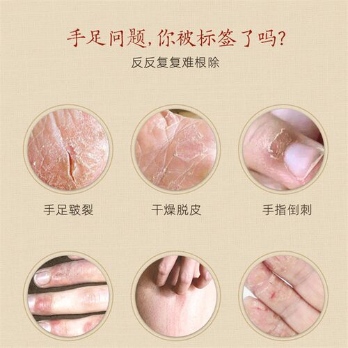 新品治手f裂的 手开裂【抖音同款】