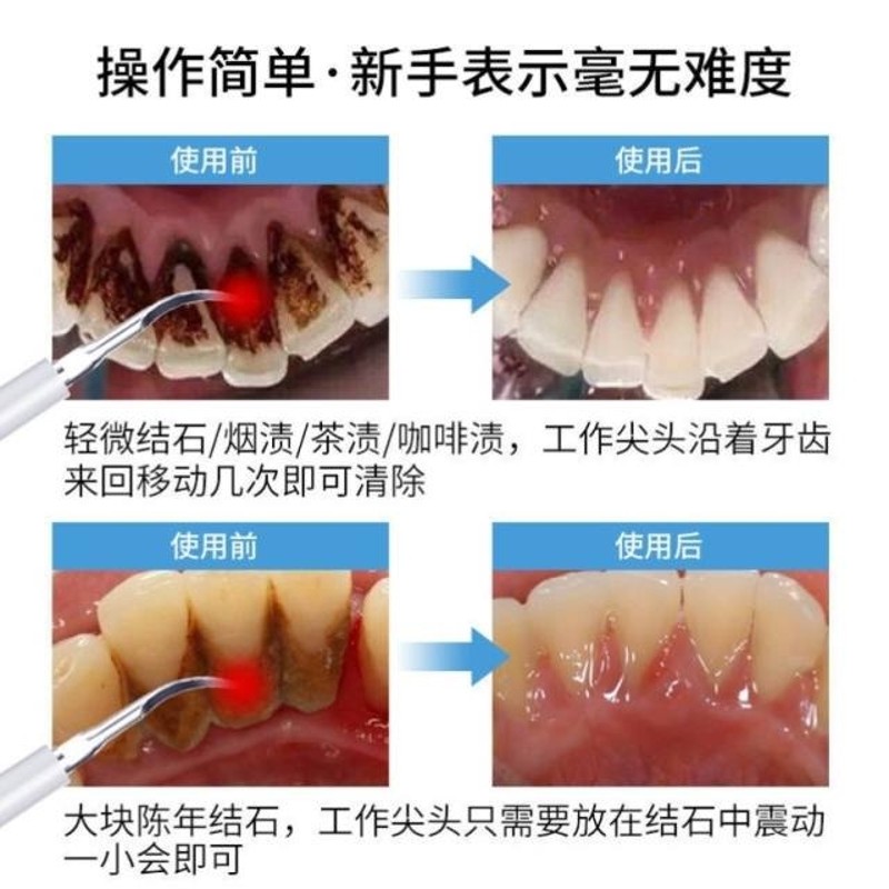好货掏剔抠牙结石神器扣牙石清理刮牙垢器清除工具去除器头专业声