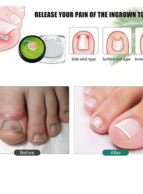 极速10PCS/set Ingrown Nail Pad Flexible Ortho NailV Filling