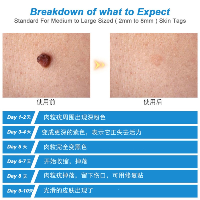 血管痣去除红痣斑血管皮肤身上长小红点去除血管痣膏幼儿血痣药