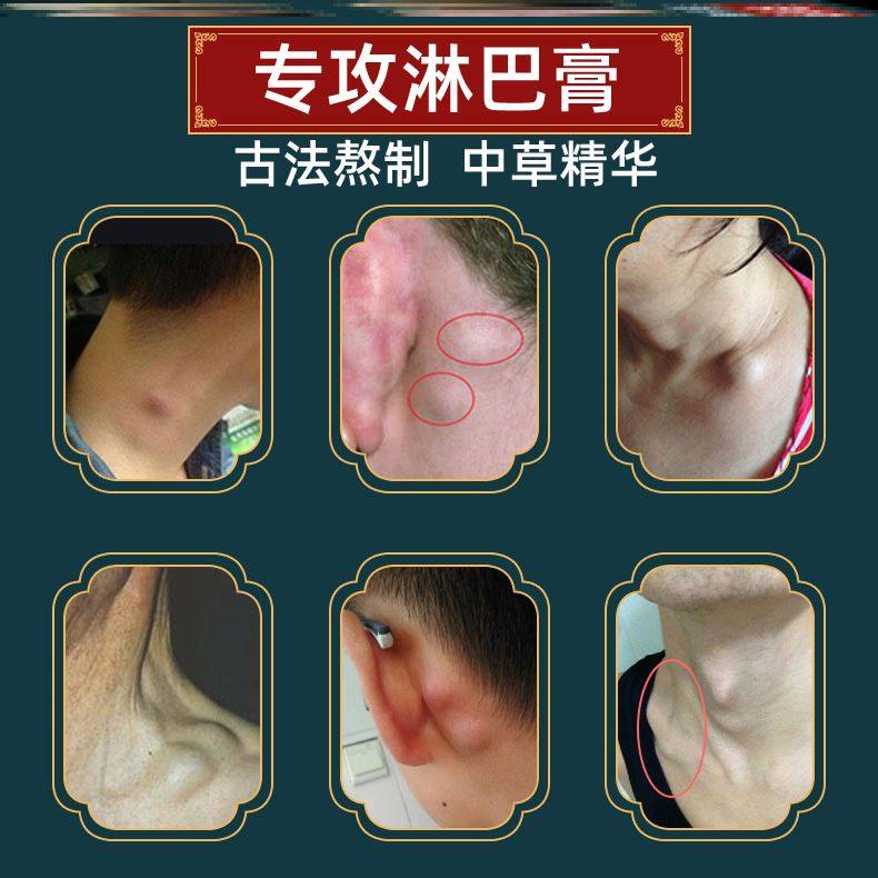 淋巴结炎消药乳腺增生结节散结贴中乳房胀痛药腋窝疏通神器